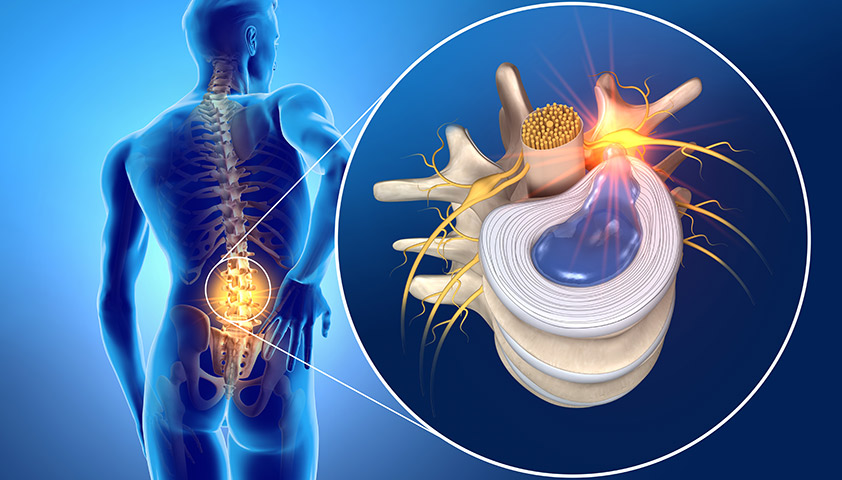 Bel Fıtığı Ameliyat Sonrası Neden Tekrarlar?