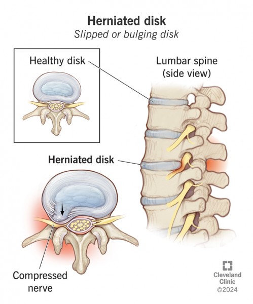 Bel Kayması Nasıl Anlaşılır? Belirtileri ve Tedavi Seçenekleri