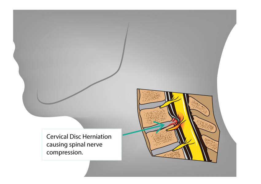 Boyun Fıtığı Baş Ağrısına Neden Olur mu? Omurga-Beyin Bağlantısı