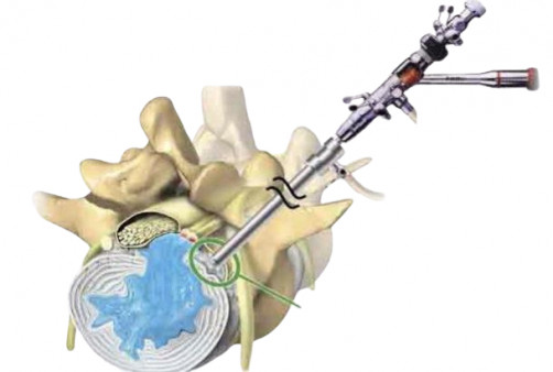 Tam Kapalı Bel Fıtığı Ameliyatı (Full Endoskopik Diskektomi) Nedir?