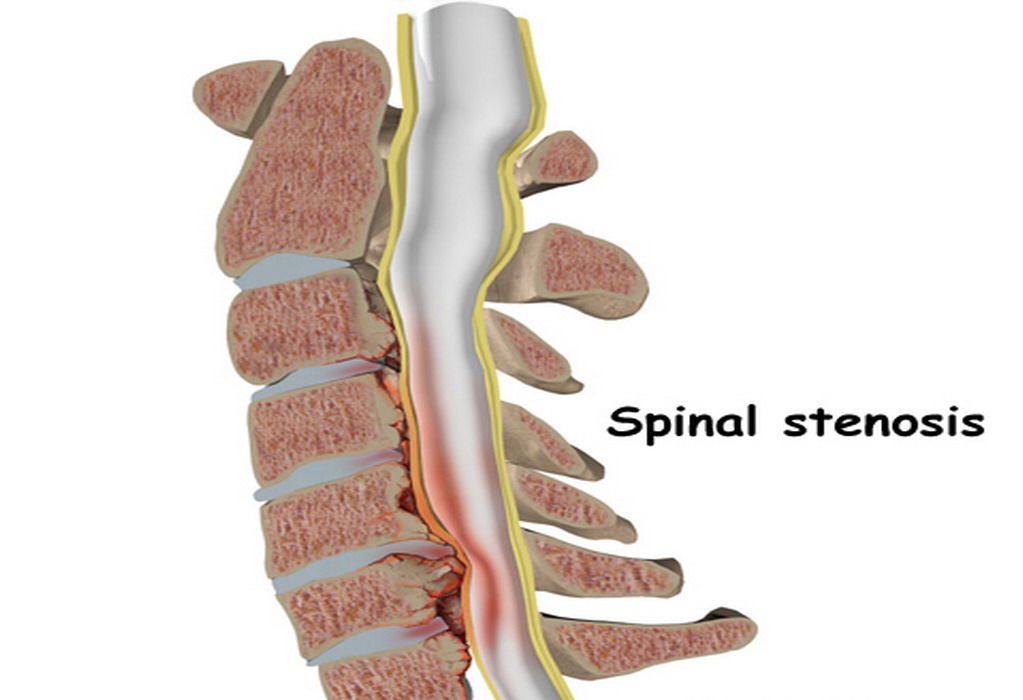 Kanal Darlığı (Stenoz) Nedir?