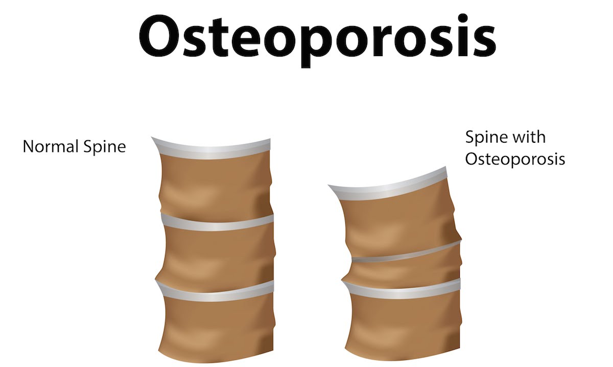Kemik Erimesine Bağlı Omurga Kırıkları ve Tedavi Yöntemleri Nelerdir?