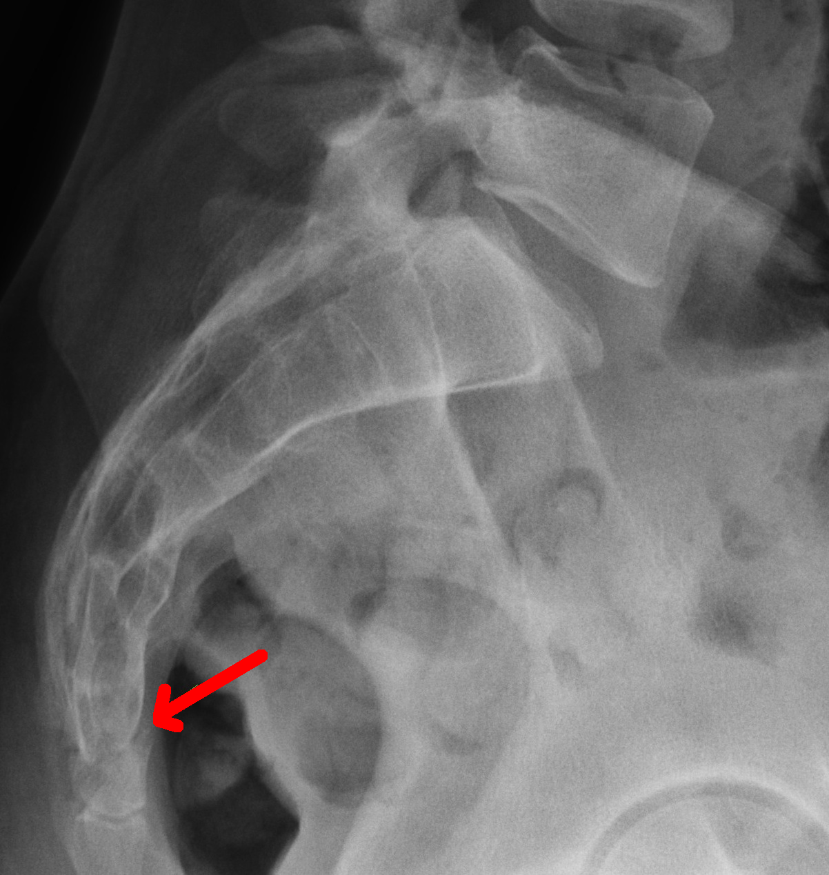 Koksiks Kırığı Belirtileri Nelerdir?