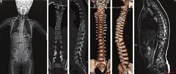 Konjenital Skolyozda Genetik Etkenler ve Cerrahi Planlama Stratejileri