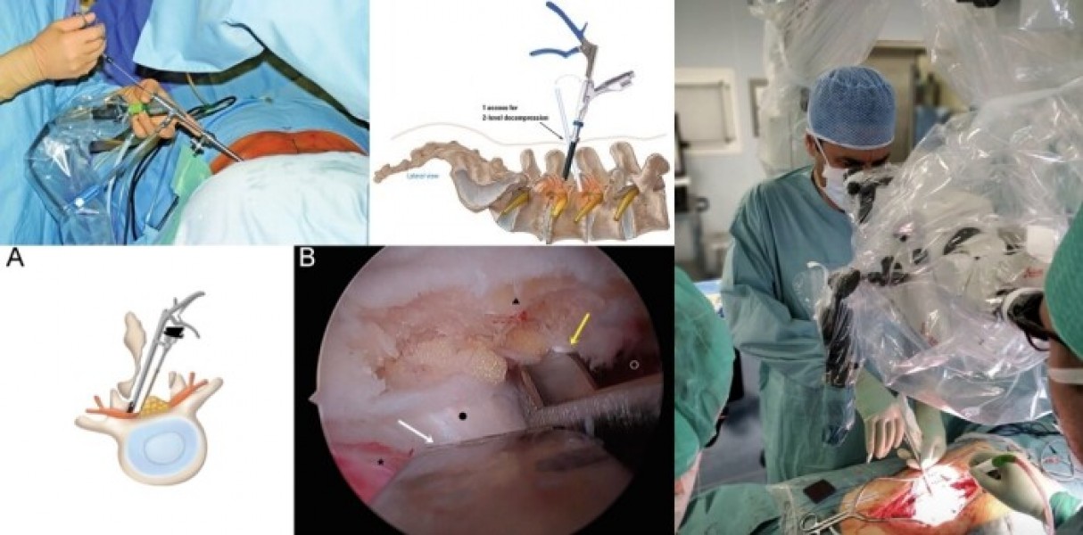 Sinir Sıkışmalarında Mikrocerrahi vs. Endoskopik Cerrahi: Hangisi Daha Etkili?