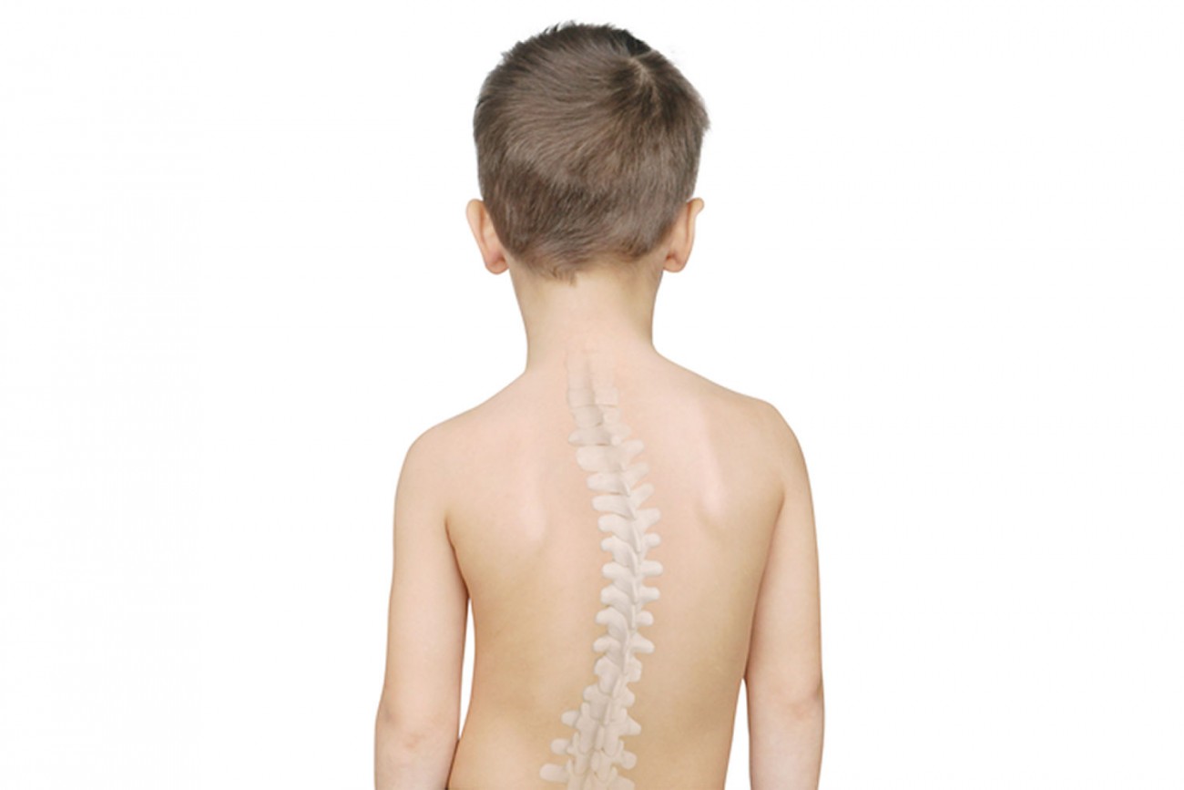 Çocuklarda Skolyoz Nedenleri Nelerdir?