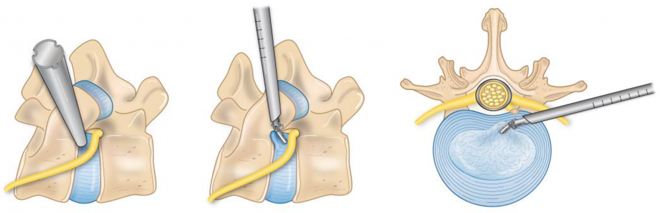 Torakal Disk Hernilerinde İnterlaminar vs Ekstraforaminal Yaklaşımlar Karşılaştırması